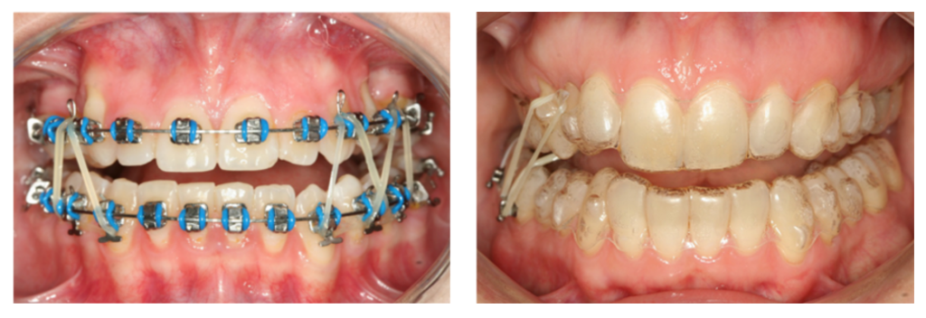 elasticos ortodoncia clases 2 y 3