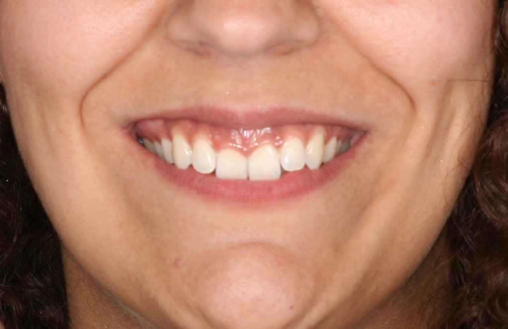 Antes de un tratamiento de Ortodoncia Insignia, a manode nuestra doctora Maite, en la Clínica dental en Cartagena