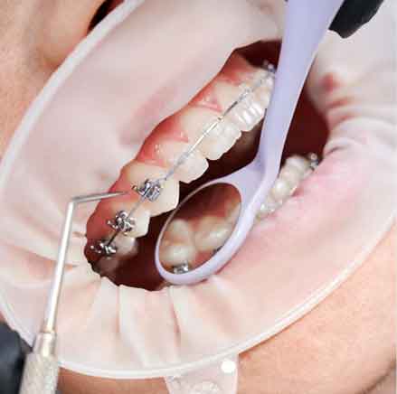 Descubre todo sobre la ortodoncia Damon, una técnica avanzada de ortodoncia que ofrece tratamientos más rápidos, cómodos y efectivos. Conoce cómo funciona, sus beneficios y si es la opción adecuada para ti.