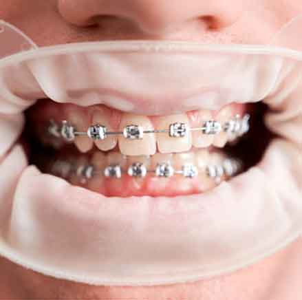 Descubre todo sobre la ortodoncia Damon, una técnica avanzada de ortodoncia que ofrece tratamientos más rápidos, cómodos y efectivos. Conoce cómo funciona, sus beneficios y si es la opción adecuada para ti.
